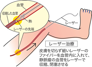 下肢静脈瘤レーザー治療