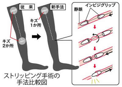 ストリッピング手術の手法比較図